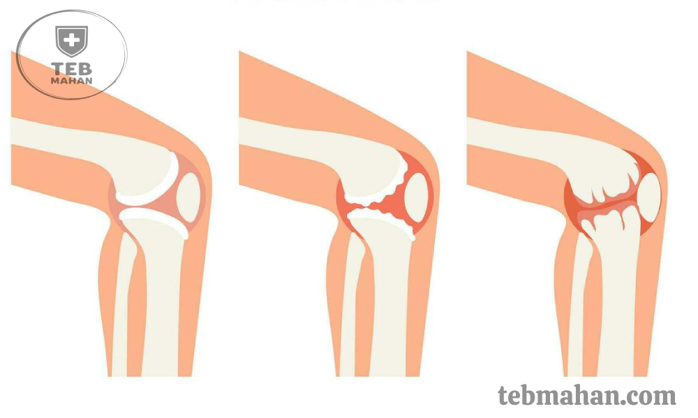 عکس آرتروز زانو