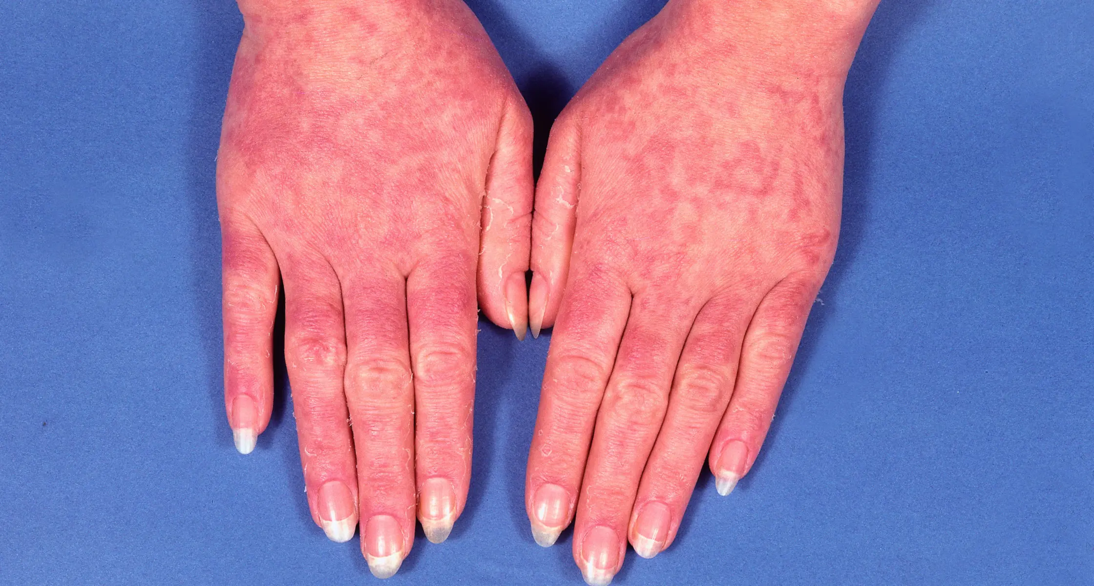 لوپوس اریتماتوز سیستمیک