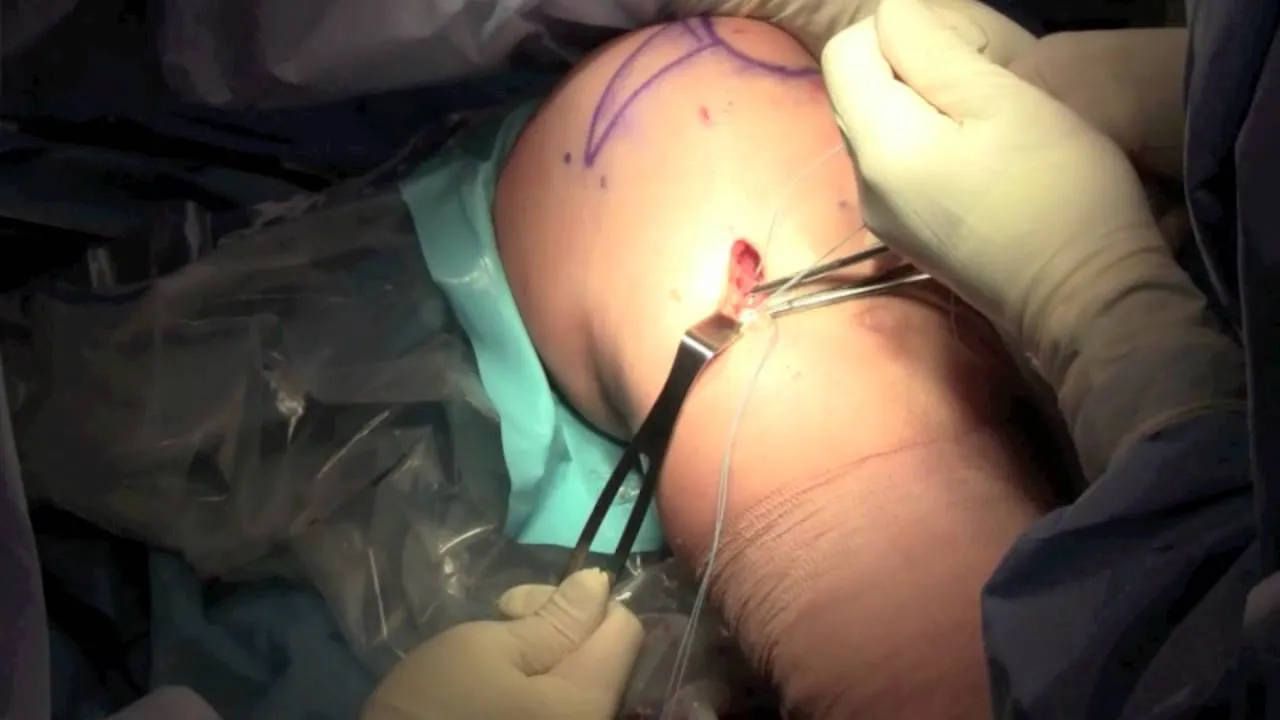 جراحی تکان خوردن زانو