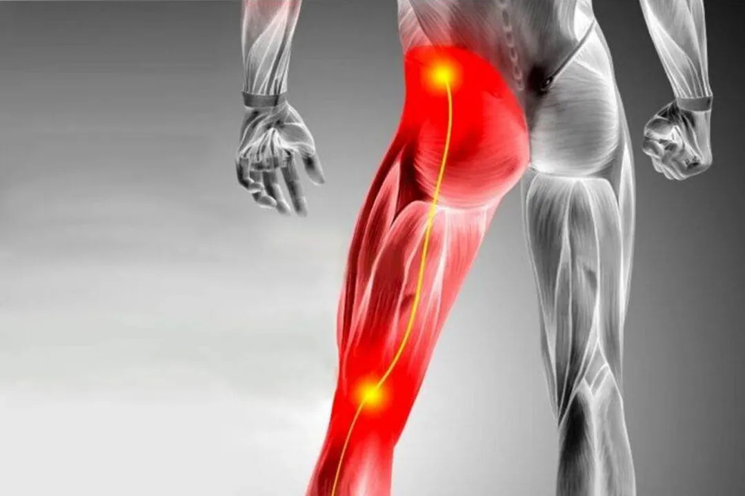 جراحی سیاتیک